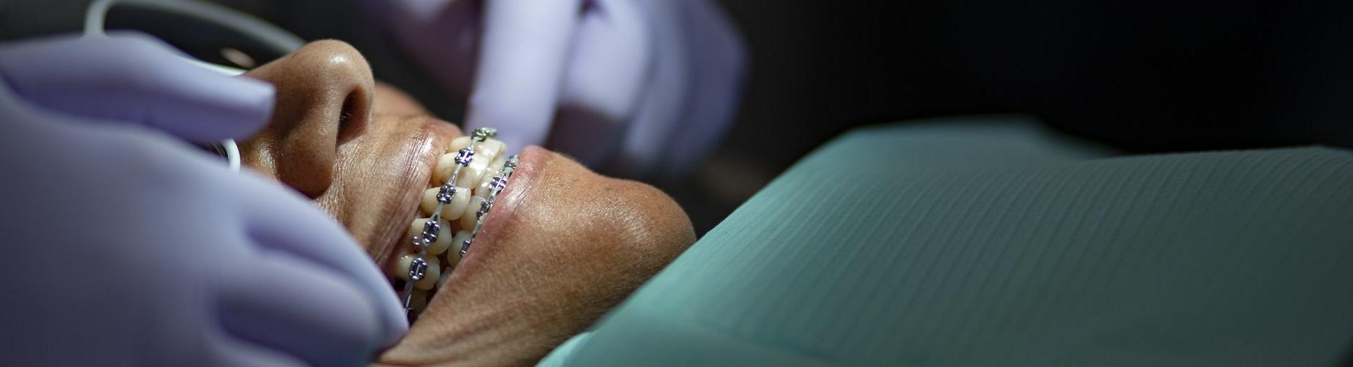 An orthodontics patient with braces being treated by a dentist wearing purple latex gloves.